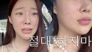 피부과 시술 부작용 Vlog…ㅠ 내 피부 돌려줘.. 다신 안해…🫠ㅣMINCARONG