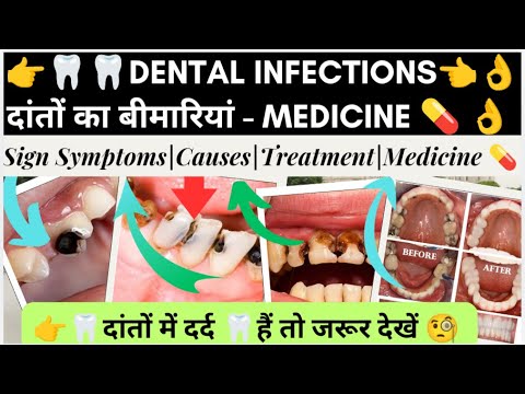 दांतों में संक्रमण | Dental Infections | कारण | Medicine knowledge | Doctor | Dentist  | Nursing