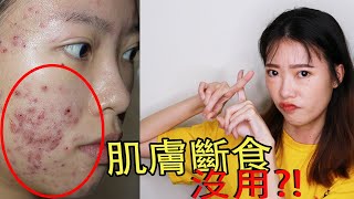 肌斷食解決痘痘 || Skin Fasting