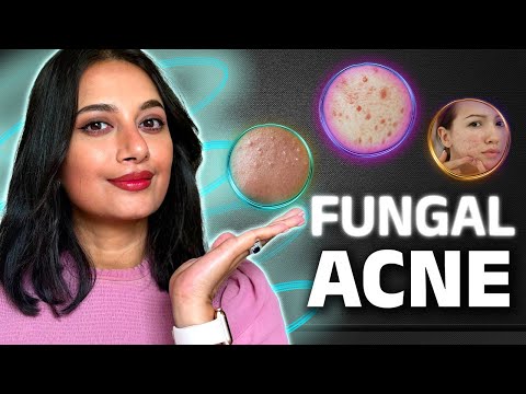 ফাংগাল একনি: কারন ও প্রতিকার॥Fungal Acne: Causes, Symptoms and Treatments