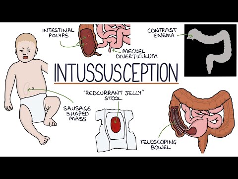 Understanding Intussusception