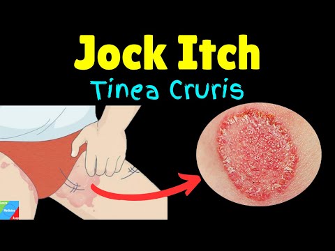 Jock Itch (Tinea Cruris): Symptoms, Causes, Diagnosis, Treatment | Ringworm of the Groin