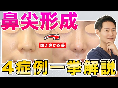 【鼻整形】団子鼻を卒業！タイプ別の治療方法を解説！【鼻尖形成】