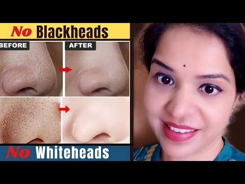 Remove blackheads whiteheads clogged pores naturally & get flawless glowing skin. permanent results