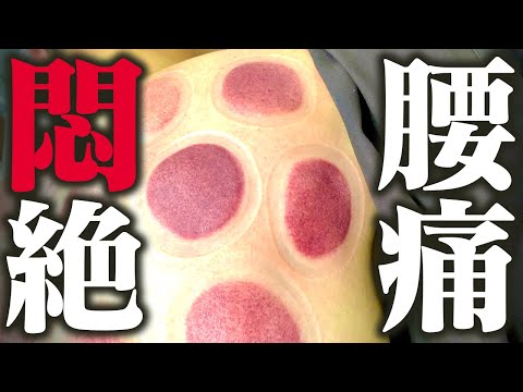 【吸い玉 鍼】悶絶吸い玉と長鍼の合せ技で腰痛が劇的改善！？