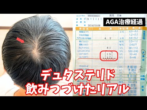 フィナステリドからデュタステリドに切り替えた結果…効果と副作用がヤバい！【薄毛・AGA経過】