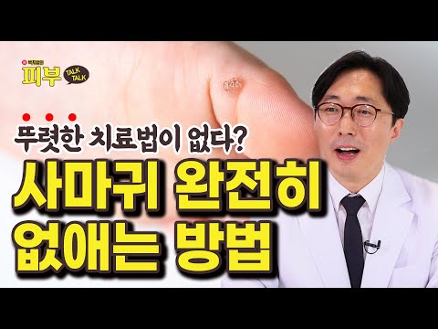 자꾸만 재발하는 사마귀로 고통받고 있다면 ‘이 치료법’을 써보세요! - 박치영의 피부 톡톡 #139