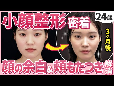 【小顔整形】「ダイエットをしても顔だけ脂肪が落ちない」頬と二重アゴのもたつきが気になる24歳スタッフさんの脂肪吸引に密着！