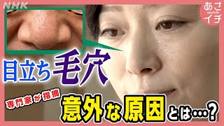 目立つ毛穴！意外すぎる原因は…？スペシャルケア教えます！ | あさイチ | NHK