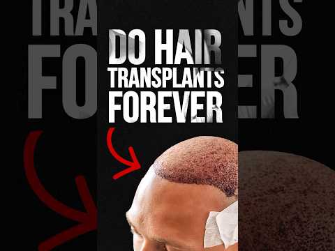 Do Hair Transplants Last Forever? #hairtransplant