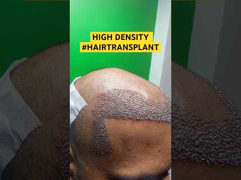 #hair transplant #hair #hairloss #besthairtransplant #drpranilmore #ytshorts #shorts #highdensity