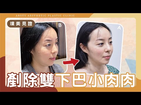 【輪廓線抽脂】剷除雙下巴小肉肉，追求理想的完美V臉！ | 璞美整形外科醫美診所