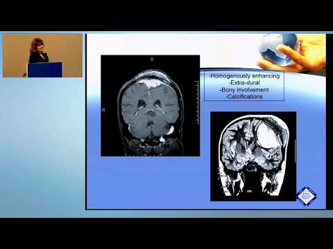 Malignant Meningioma