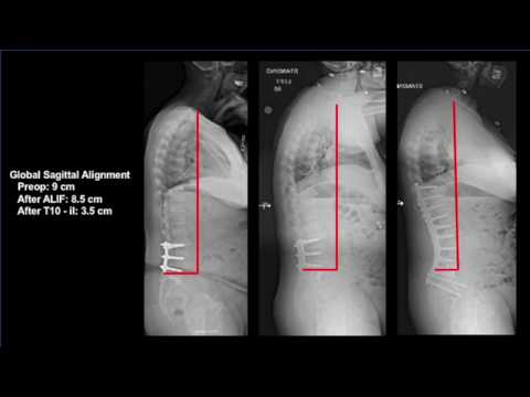 Revision thoracolumbar surgery for flat back deformity: staged ALIF & poste column osteotomies...