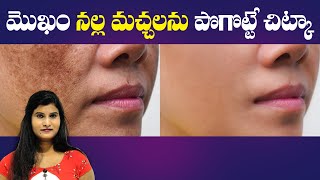 Tips to Reduce Melasma Spots Naturally | Home Remedies to Recude Mangu Machalu | Lilly Beauty Mantra