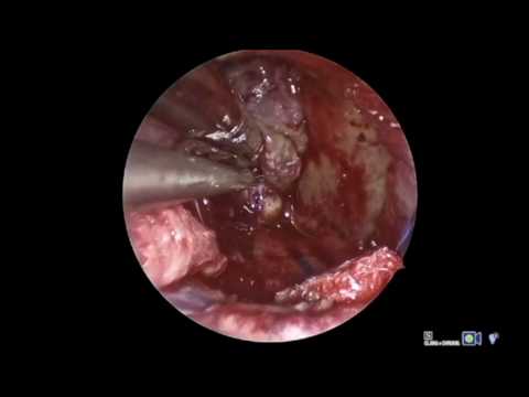 Endoscopic endonasal resection of giant pediatric craniopharyngioma: impact on hypothalamic edema