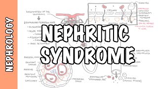 Nephritic Syndrome - classification, pathophysiology, treatment (RPGN, ANCA, Immune complex)