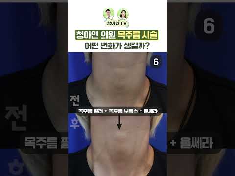 청아연의원 목주름 시술 전후 개선 사례