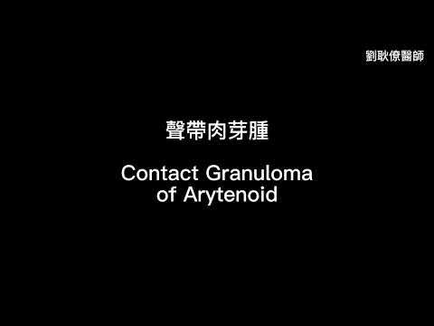 聲帶肉芽腫 arytenoid granuloma contact granuloma