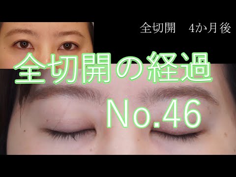 全切開二重手術　46　モニター様4か月目の経過