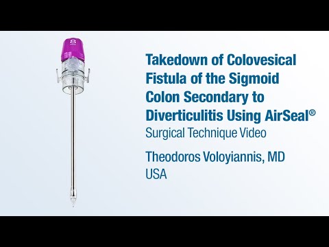 Dr. Theodoros Voloyiannis - Takedown of Colovesical Fistula of Sigmoid Colon Using AirSeal® - CONMED