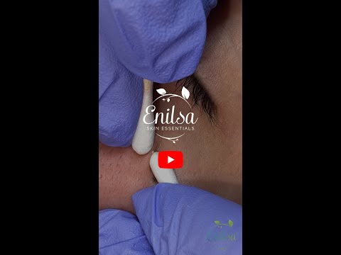 Milias Extractions on K ⚡️Short Video⚡️