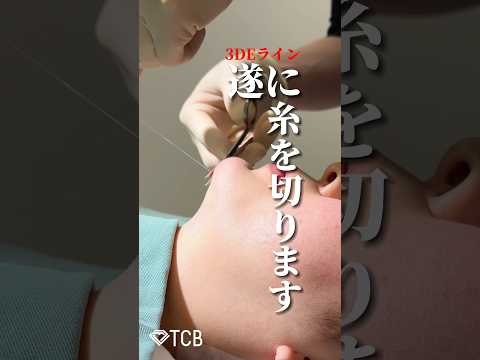 【顎整形】遂に糸切ります！#shorts