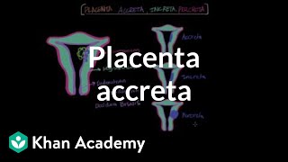 Placenta accreta |  Reproductive system physiology | NCLEX-RN | Khan Academy