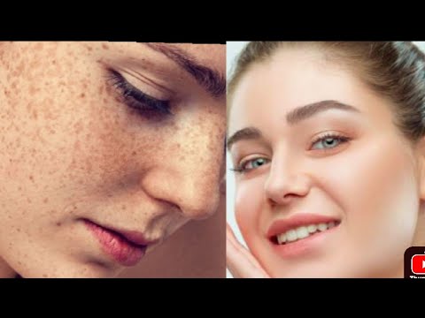 How to remove frackles and spots from your face| cream to remove dark spots+sunscreen| fashion 💅