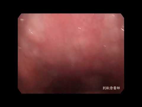 下咽癌 hypopharyngeal cancer