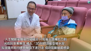 人工關節染蜂窩性組織炎 八旬翁走路痛如刀割光吃抗生素無效 植入「3D列印活動型骨水泥」 術後隔天即可使用輔具下床行走 成功阻斷細菌感染