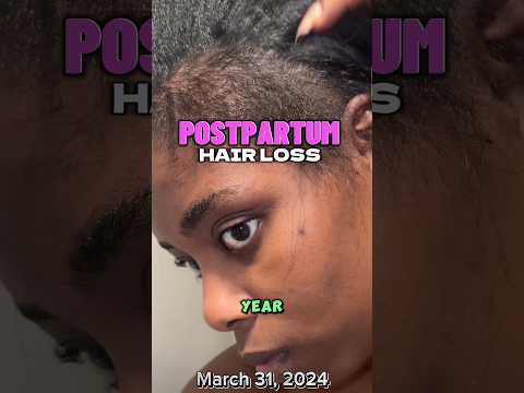 Postpartum hair loss #hairlosstreatment #postpartum #postpartumhairloss #hairgrowthoil #hairgrowth