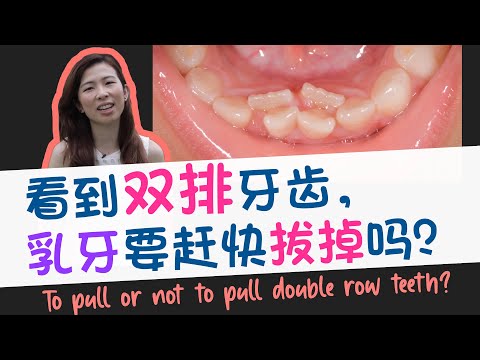 EP 35 : 孩子在换牙期出现雙排牙齒，一定要剛快拔嗎？ To Pull or not to pull double row teeth?