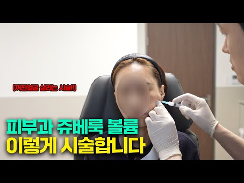 울퉁불퉁 땅콩형 얼굴 개선하는 쥬베룩 볼륨 시술 직접 보여드리겠습니다