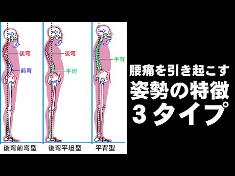 腰痛を引き起こす姿勢3タイプ！腰痛の原因を世界一わかりやすく解説【後編】