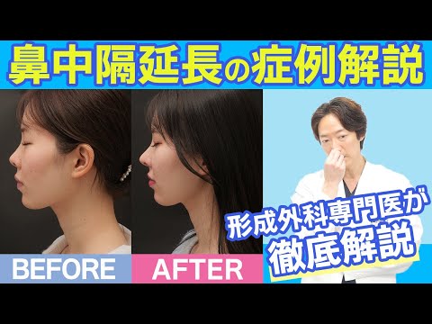 【鼻先を綺麗にしたい方必見！】鼻中隔延長の症例解説