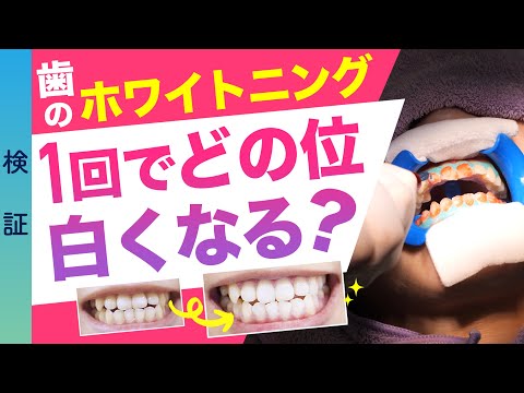 【歯科のホワイトニング】1回でどのくらい白くなる？痛い？オフィスホワイトニング＊検証＊