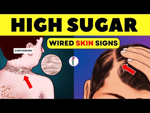 Insulin Resistance - Wired Skin Signs | Reverse insulin resistance | Diabetes mellitus