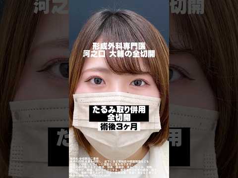 【二重整形/ダウンタイム】たるみとり併用全切開法二重術の術後経過🤝🏻形成外科専門医の河之口大輔先生の症例です #shorts #二重整形 #全切開 #全切開二重術 #形成外科専門医