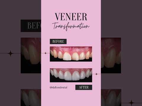 Another amazing veneer transformation for a stunning patient!