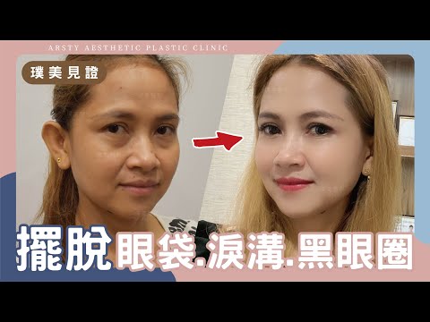 擺脫眼袋、淚溝、黑眼圈！一站式眼周年輕化拯救外國美女憔悴顏 | #璞美 #陳心瑜醫師 #眼袋手術