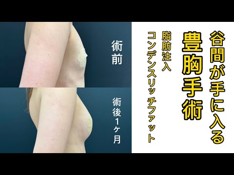 自分の脂肪で豊胸手術！大きな胸を手に入れよう！