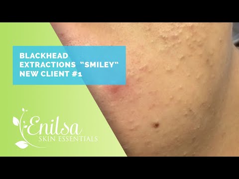 Blackhead Extractions "Smiley" New Client #1