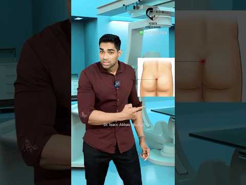 பின்புறத்தில் கட்டி | Pilonidal sinus- Dr. Isacc Abbas