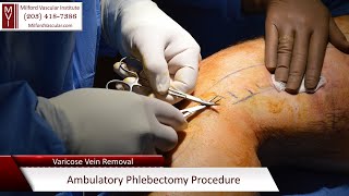 Varicose Vein Removal New Haven CT Ambulatory Phlebectomy Procedure By Best Vascular Surgeon