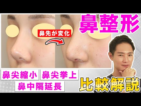 【鼻整形】鼻中隔延長と鼻尖縮小と鼻尖挙上のどれを受けるべき？