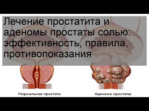 Лечение простатита и аденомы простаты солью: эффективность, правила, противопоказания