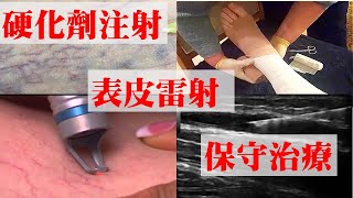 靜脈曲張的各種治療方法與歷史（下篇：硬化劑注射治療、表皮雷射、與保守治療）｜許原彰醫師：台中，高雄，台南，台北，新竹，靜脈曲張專家