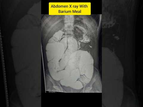 Abdomen X ray with Barium Meal