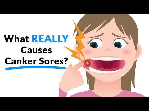 What REALLY Causes Canker Sores?